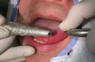 舌の上に繁殖している細菌を「ライトタッチレーザー」で殺菌