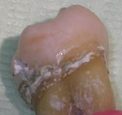 歯石のついた歯