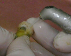 歯石のついた歯