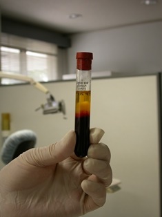 PRFによる骨造成の技術と器材を導入 PRFによる骨造成の技術と器材を導入