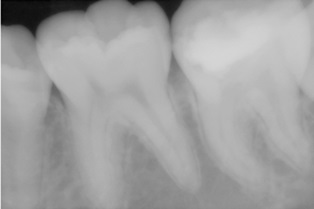 新しい歯質ができ始めているように見えます