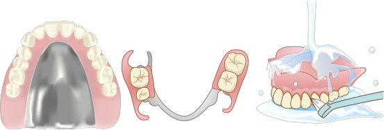 入れ歯の種類 入れ歯の種類