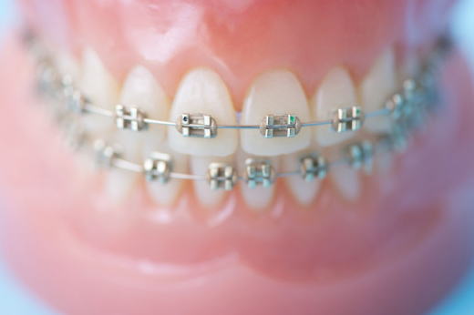 矯正治療 矯正治療