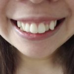 八重歯は気になる?~八重歯が生える原因って?~