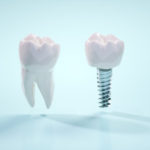 インプラントの歯周病？～インプラント周囲炎って知っている？～