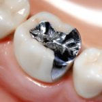 詰め物・かぶせ物が外れてしまったら、どうしますか？